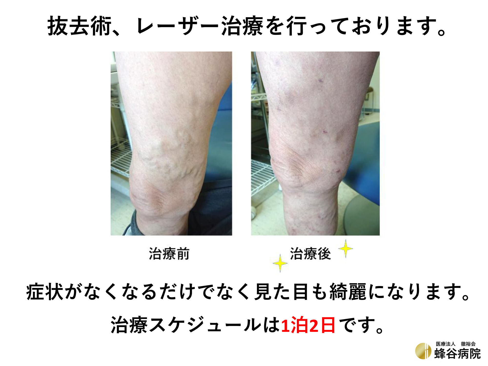 下肢静脈瘤 治療前と治療後