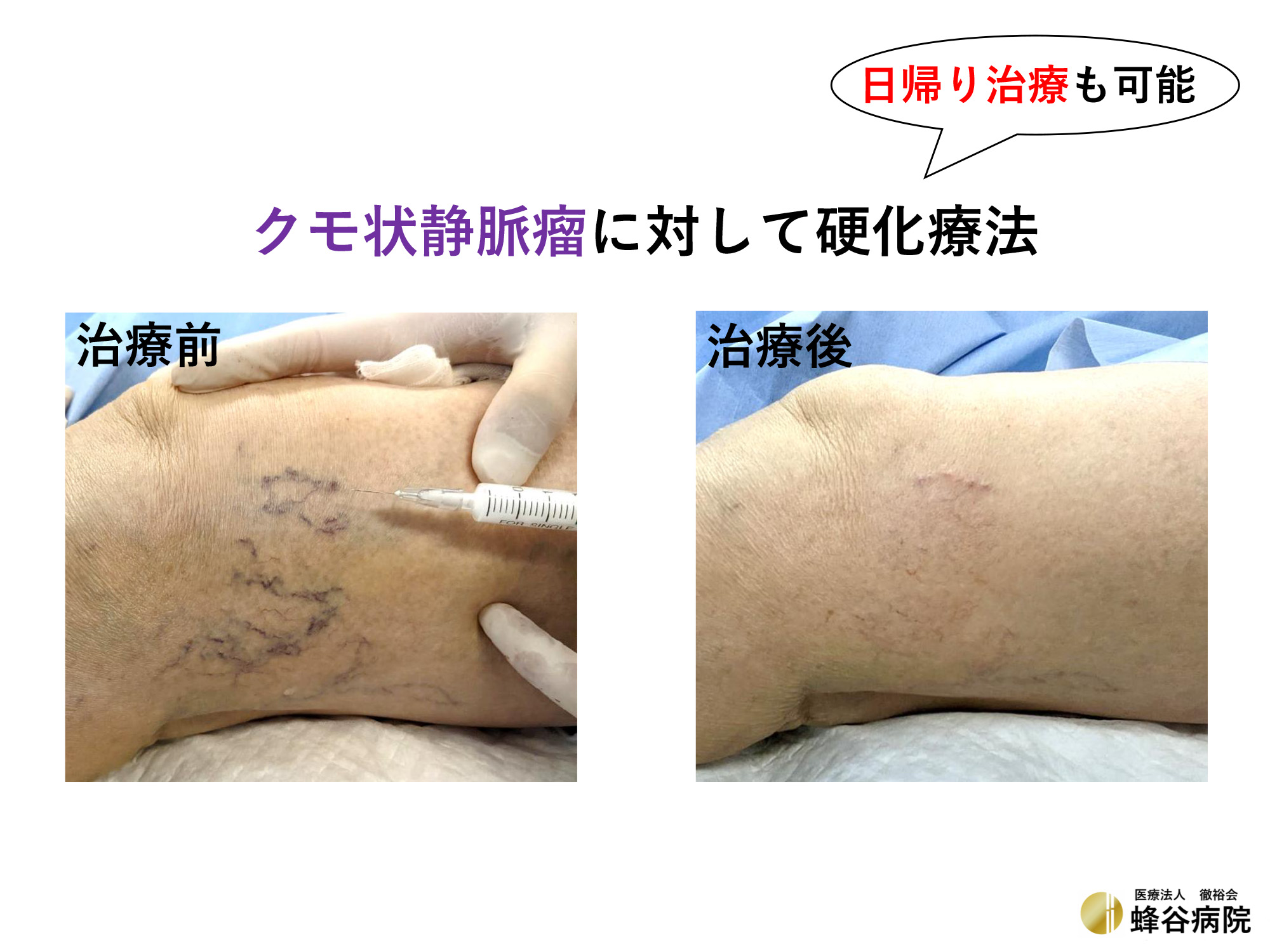 クモ状静脈瘤 治療前と治療後