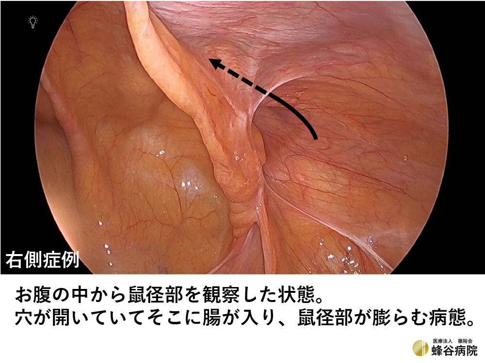 腹腔鏡下鼠径ヘルニア手術