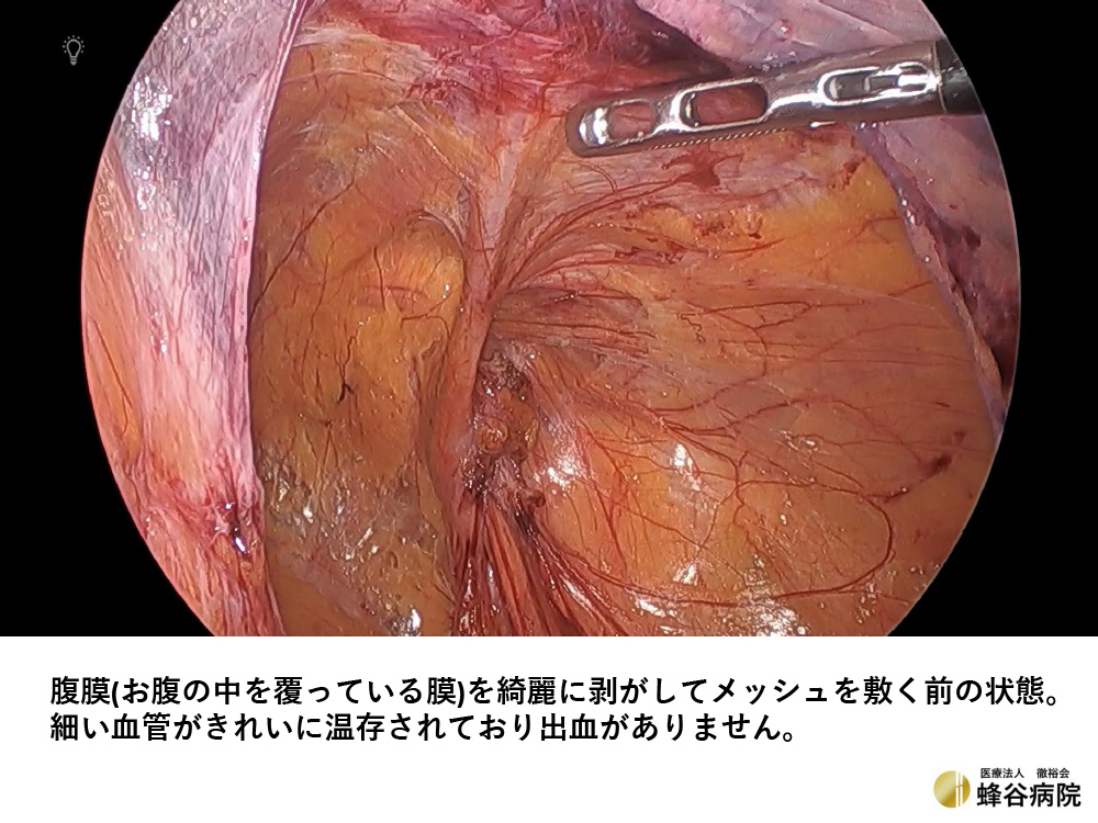 腹腔鏡下鼠径ヘルニア手術