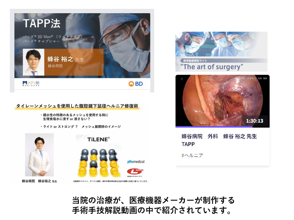 タイレーンメッシュ使用の腹腔鏡下鼠径ヘルニア修復術